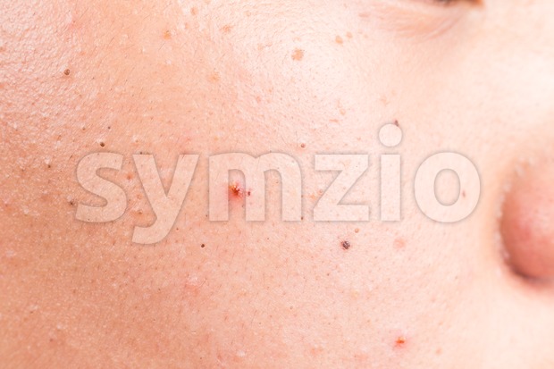 Ugly pimple acne blackhead on the face of a teenager Stock Photo