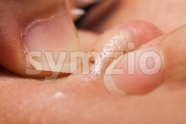 Squeezing pimple blackheads from the nose of a teenager using finger nails Stock Photo