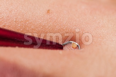 Squeezing pimple blackheads from the face of a teenager using a pimple popper Stock Photo