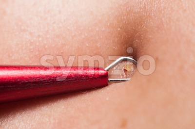 Squeezing pimple blackheads from the face of a teenager using a pimple popper Stock Photo
