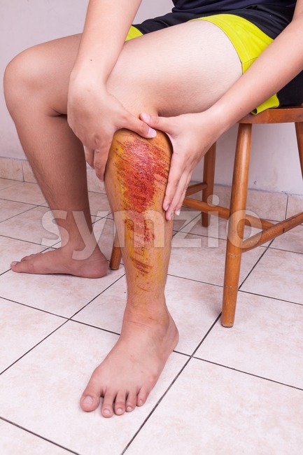 Hand embracing injured knee with painful abrasion from fall Stock Photo