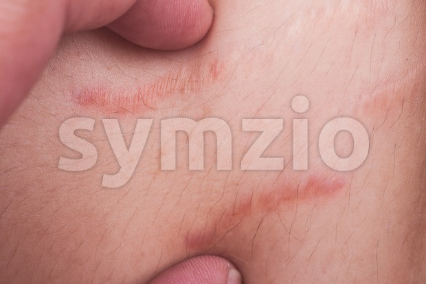 Closeup on finger embrace stretch marks or cellulite on belly Stock Photo