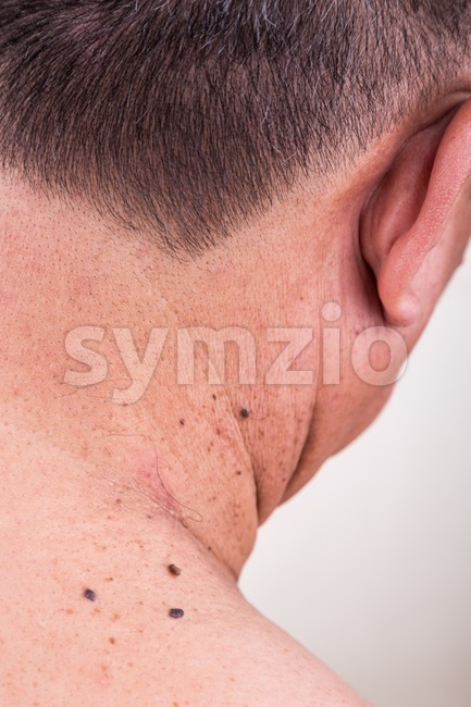 Multiple mole on neck and shoulder of Asian male Stock Photo