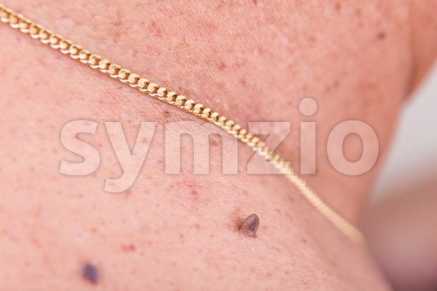Closeup of elevated mole on shoulder of Asian man Stock Photo