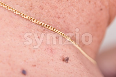 Closeup of elevated mole on shoulder of Asian man Stock Photo
