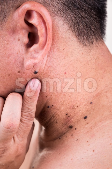Finger embrace mole on neck and shoulder of Asian male Stock Photo