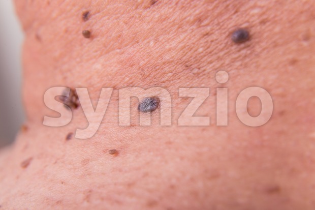 Closeup of multiple moles on shoulder of Asian man Stock Photo