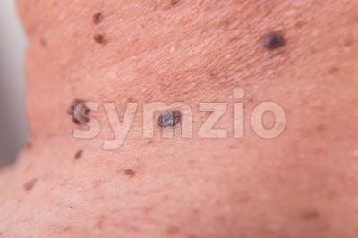 Closeup of multiple moles on shoulder of Asian man Stock Photo