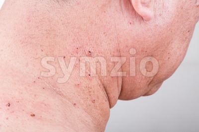 Mole removed via skin graft procedure leaving scar Stock Photo