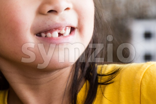 Kid with toothless and deformed front teeth Stock Photo