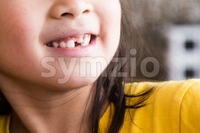 Kid with toothless and deformed front teeth Stock Photo