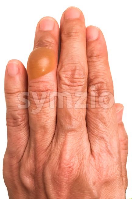 Close-up on finger with painful inflammed fluid-filled blister Stock Photo