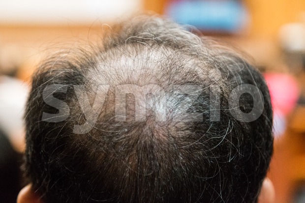 Close-up of balding and thinning hair of man Stock Photo